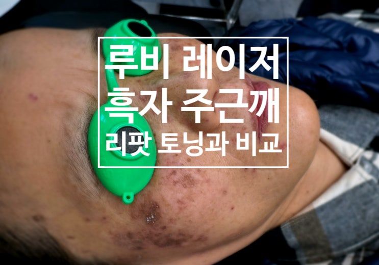  안산 흑자 루비레이저 딱지 앉나요. 기미색소토닝과 차이점 (의사직접작성, 의학지식공유)