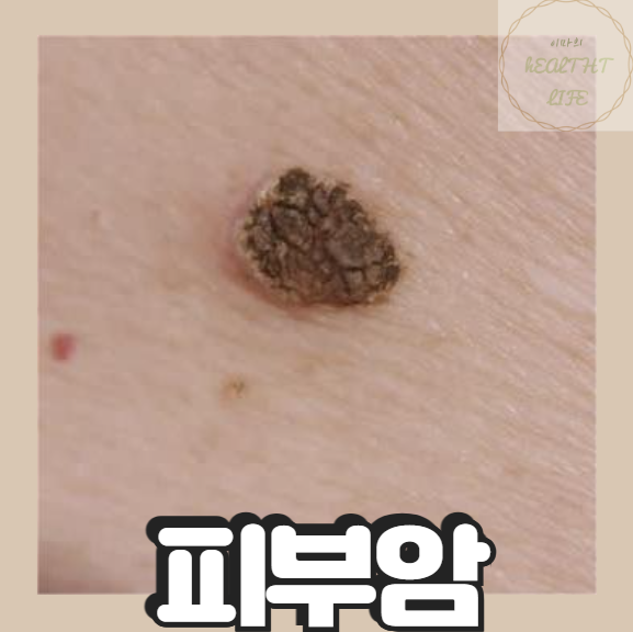 피부암전조증상 말기 생존률