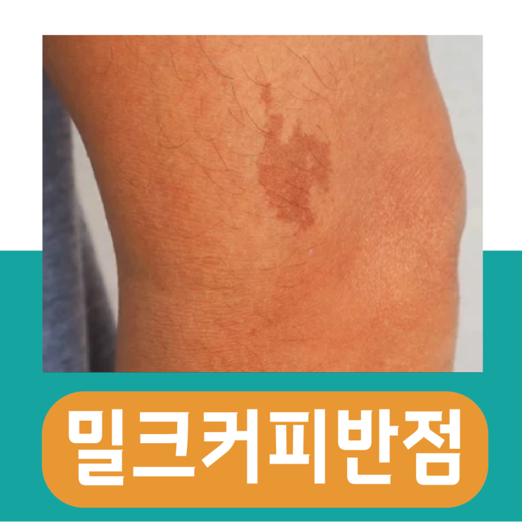  성인 밀크커피반점, 신경섬유종이 원인?