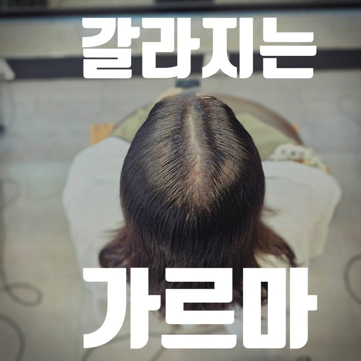  30대 여성 갈라지는 가르마, 모류교정 링거펌으로 뿌리볼륨 살리기