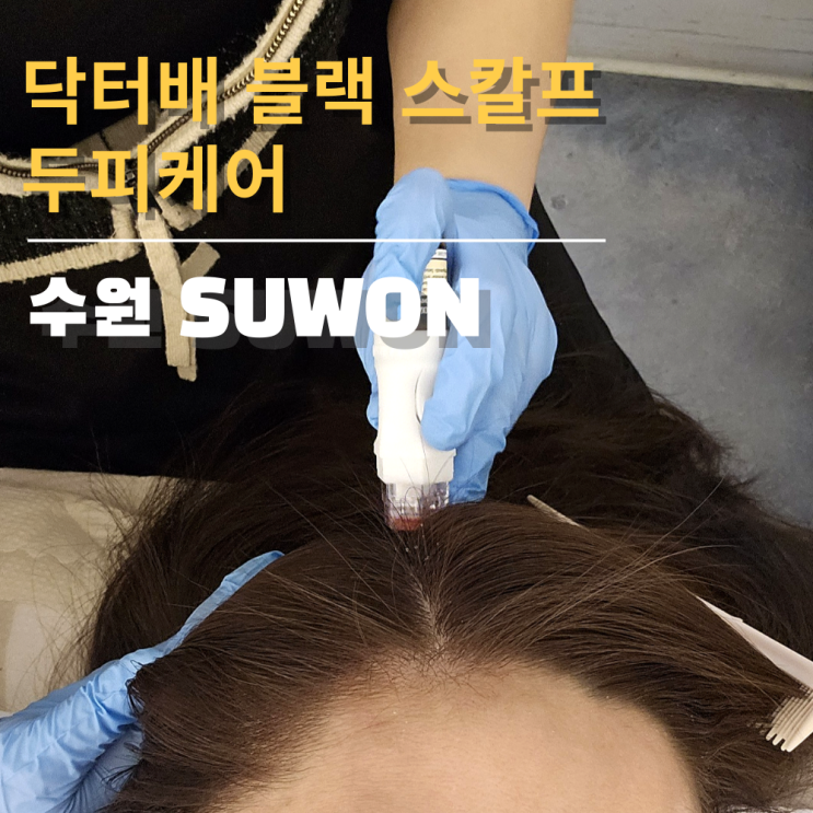 수원두피관리 바라에스테틱 닥터배 블랙 스칼프 마이크로젝션 후기 수원두피관리 바라에스테틱 닥터배 블랙 스칼프 마이크로젝션 후기