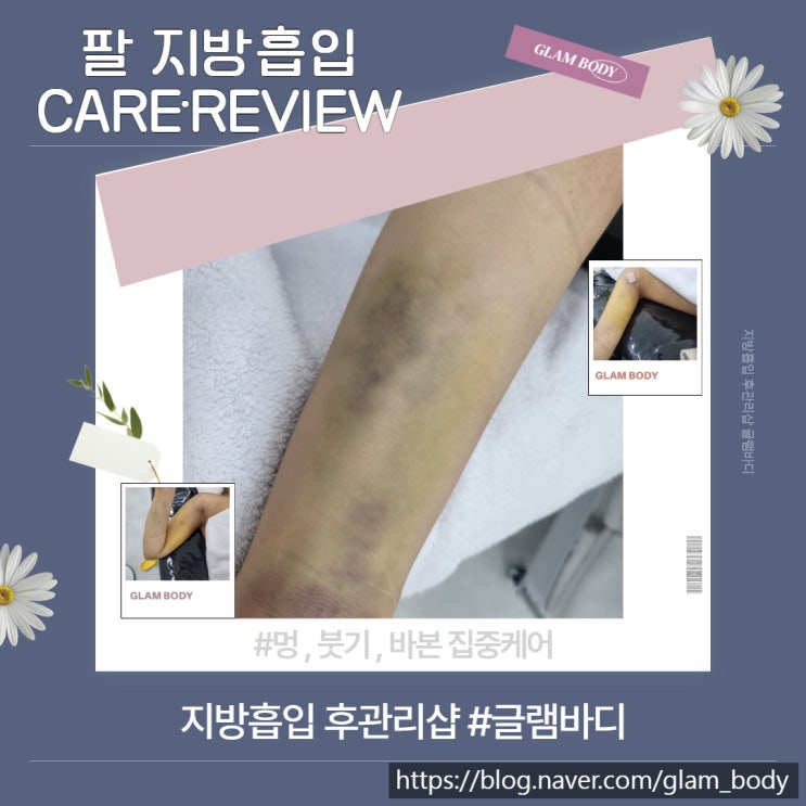  팔 지방흡입 멍,붓기 빠르게 내려드린 사례