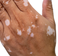  원형탈모와 관련성이 높은 자가면역질환, 백반증(vitiligo)