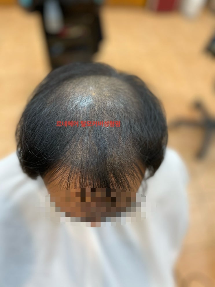  남자심한탈모 두피 ㅁㅅ까지해도어쩔수없네하지만 탈모성지르네시떼미용실부산사상머리추천잘하는헤어샵을만난다면 그레잇!/ 대연수영망미울산연산명륜연제토곡용호남천센텀영도용당가야주례학장하단김해