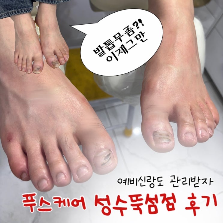  예비신랑 관리 추천! 푸스케어 성수뚝섬점 발톱무좀 케어 후기