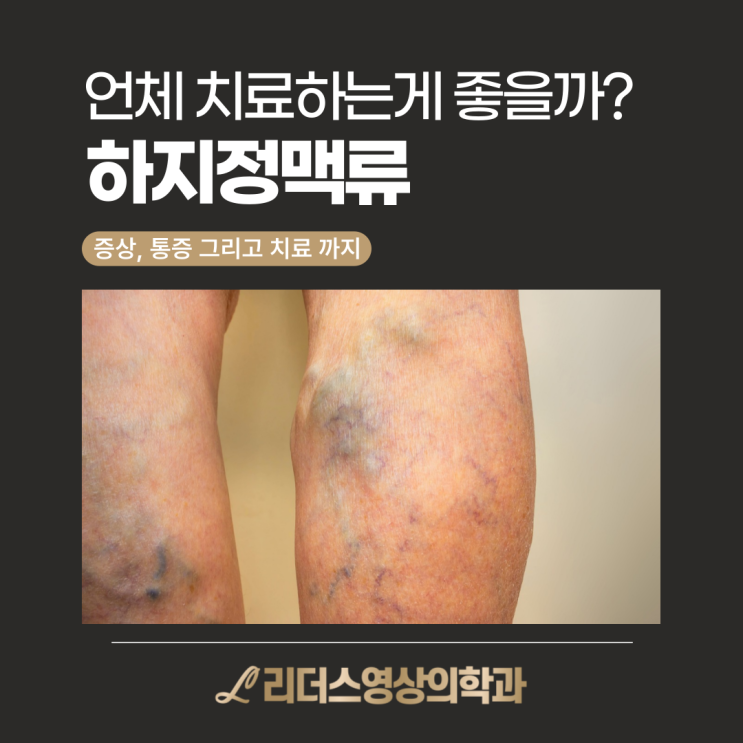  부평 하지정맥류 자가진단테스트 : 증상 통증 참지말고 치료방법 확인하세요!