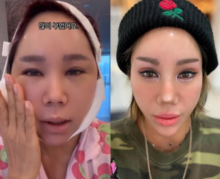 ‘<b>강원래</b><b>김송</b>’ 광대수술 후 치주염 고백, “생니 뽑는 고통”