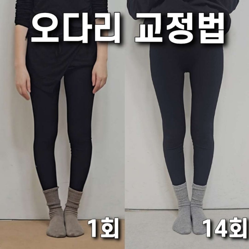 Real Reviews and Exercises for Bow Leg Correction (Girls' Generation Yoona's Bow Leg Correction)