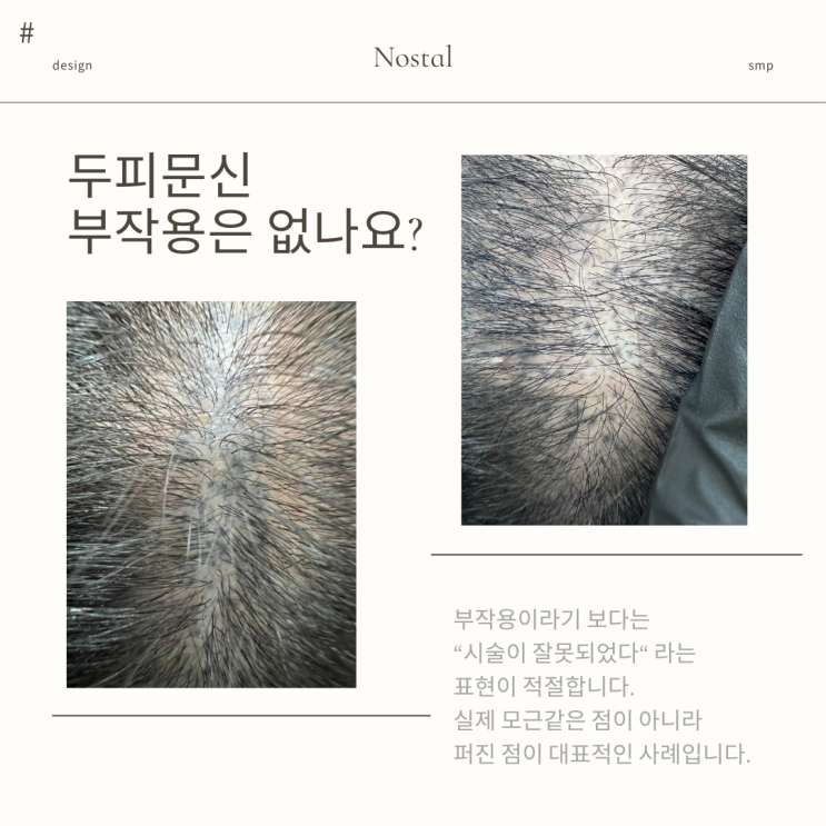  날씨에 영향 안 받는 탈모 커버, 대전 두피문신