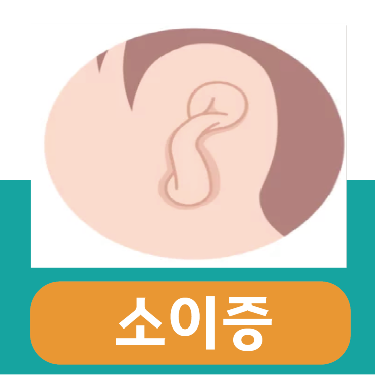  소이증 수술, 신생아 치료 방법은?