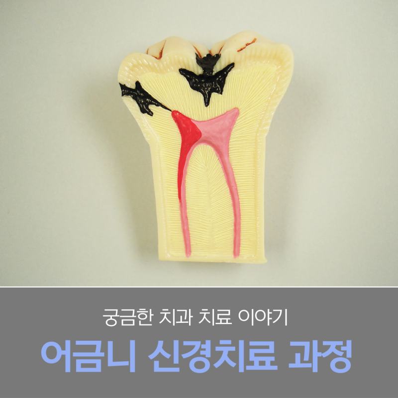 이빨 어금니 신경치료 비용 달라지는 이유