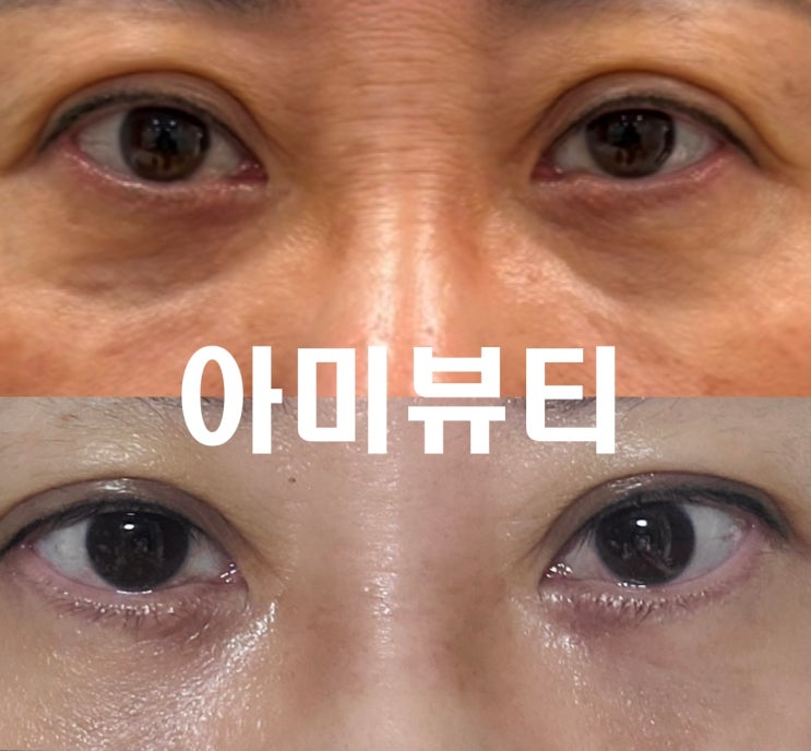  대구 피부관리 눈밑주름, 눈밑꺼짐, 다크서클 개선, 아미뷰티 플라즈마 시술