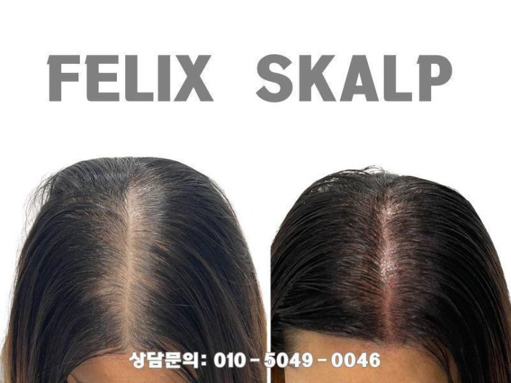  김포걸포동사우동두피문신으로 자신감 UP!탈모, 더 이상 고민하지 마세요!