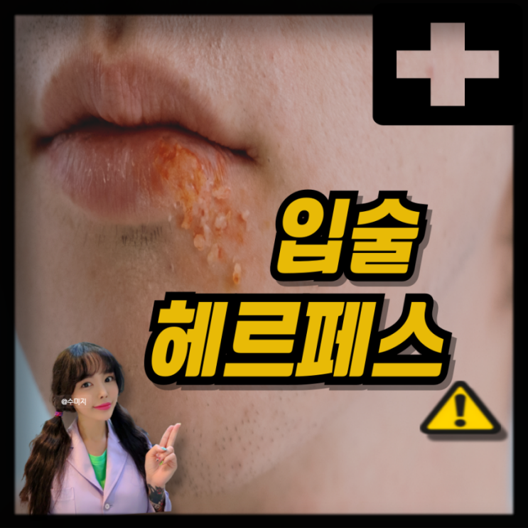  입술포진 약 단순포진 연고 아시클로버 입술 헤르페스