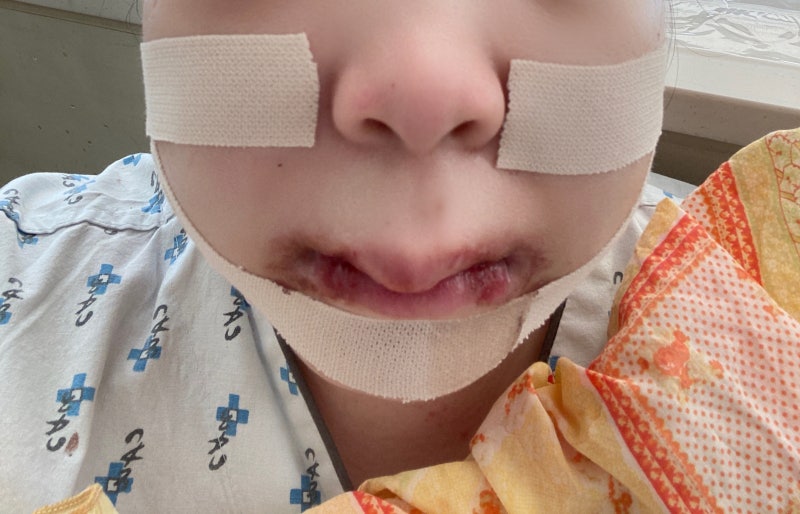 양악수술 5년차 후기(1) / 대학병원,양악수술과정,보험,수술비용,재수술