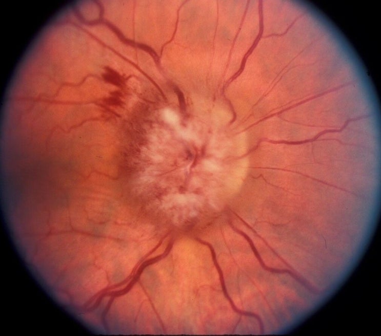시신경병증(Compressive Optic Neuropathy)의 종류와 원인 및 치료
