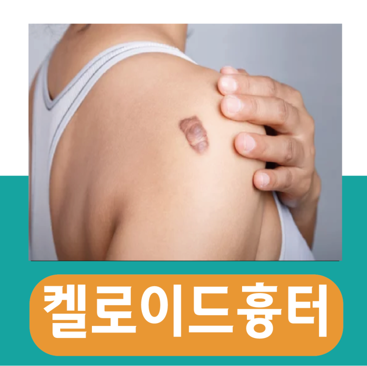 켈로이드흉터 제거 보험 / 연고 치료 방법