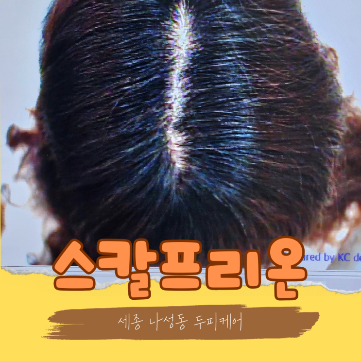  세종 두피관리 꼼꼼하게 해주는 스칼프리온 나성점에서 탈모예방하세요