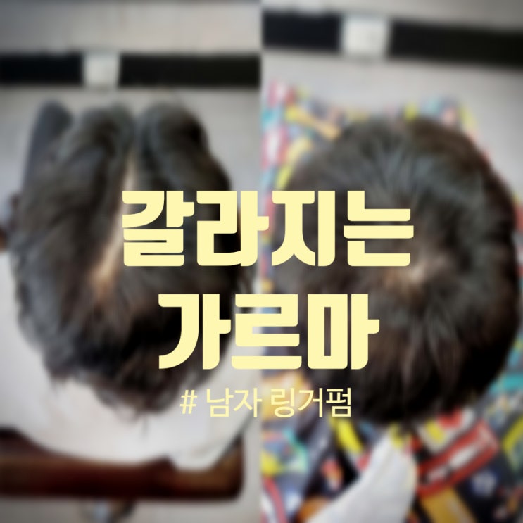  남자 가르마탈모, 갈라지는 가르마 바꾸기! 링거펌 추천