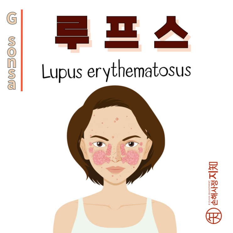  루프스 – 단순한 피곤함이 아니라 자가면역질환일 수도 있다고 해요! - [질병정보, Why]