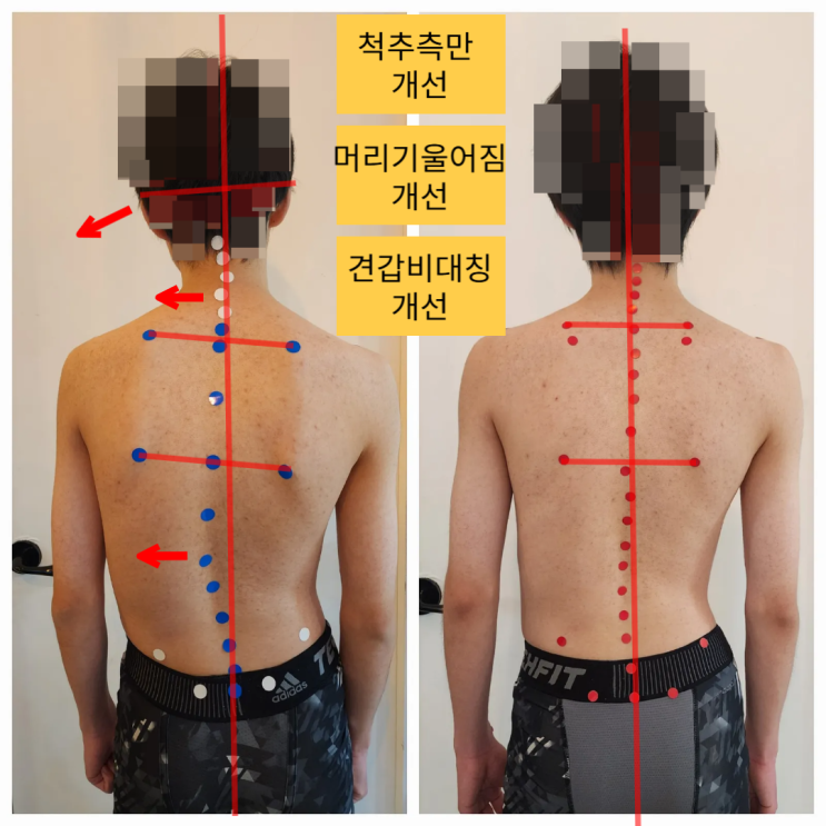  [부산 해운대 척추교정] 척추측만증 레슨 한달 후 비포에프터