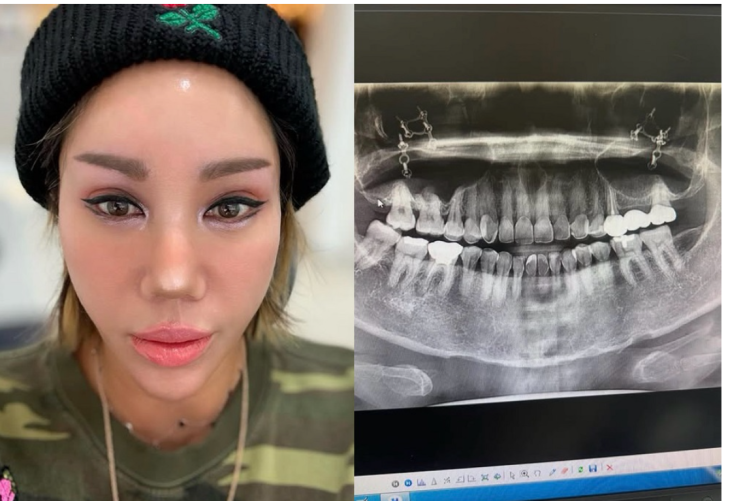 “강원래” <b>김송</b>, 대학병원 응급실행 이유 잇몸 낭종 수술까지?