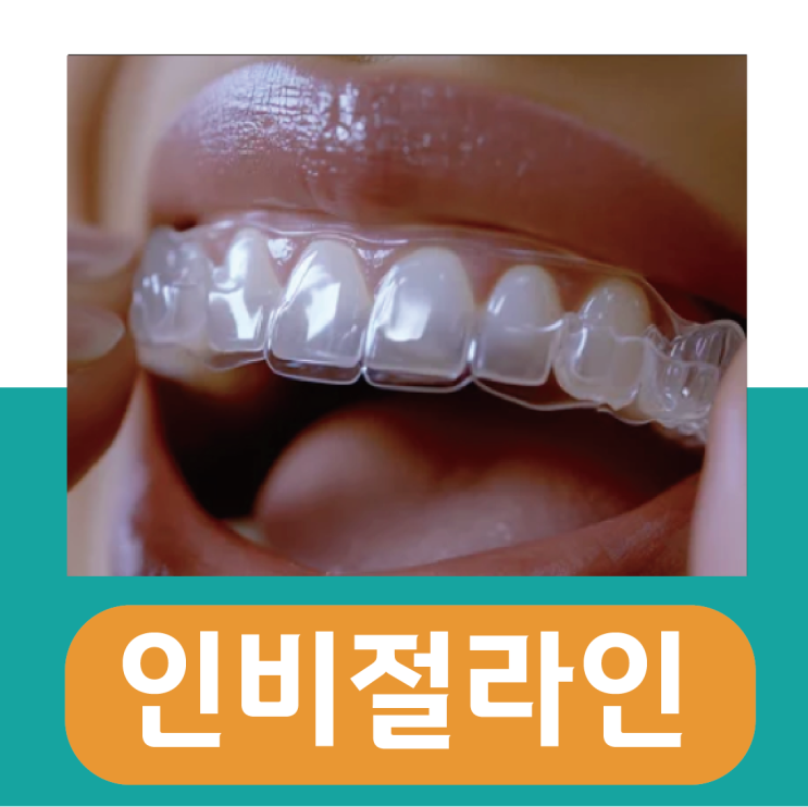  인비절라인 교정 가격, 통증 및 기간 얼마나?
