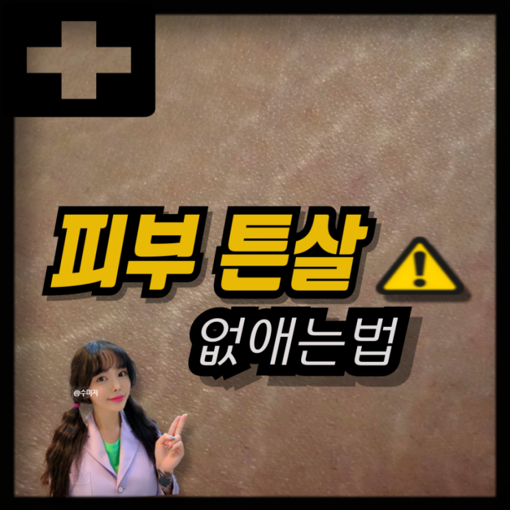  튼살 없애는법 흰튼살 붉은튼살 튼살치료 튼살오일