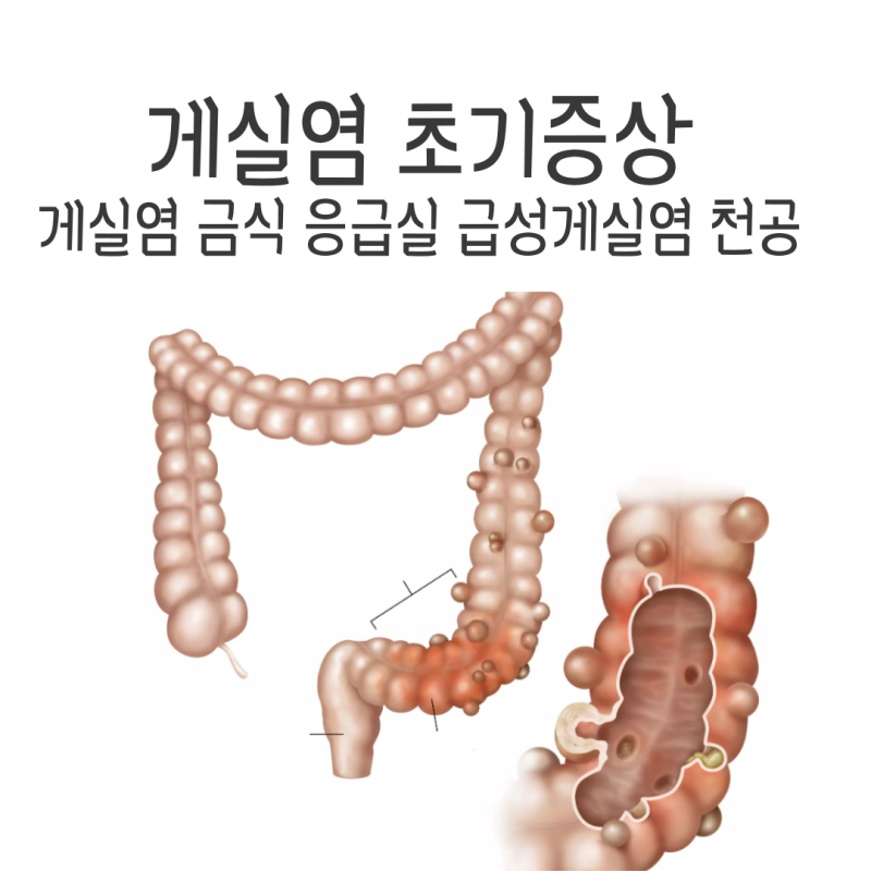 게실염 초기증상 금식 응급실 급성게실염 천공 재발 설사 게실증