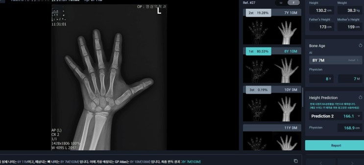  성장판과 골연령: AI를 이용한 아이의 키 성장 분석