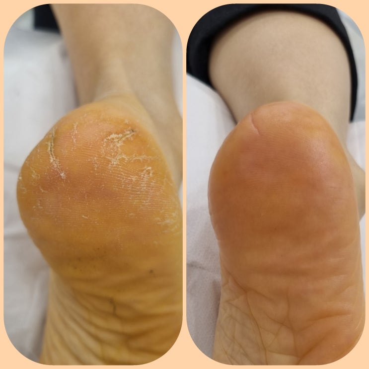  동탄 발각질 관리 재방문! 풋풋한리쌤 동탄역점에서 깨끗하게