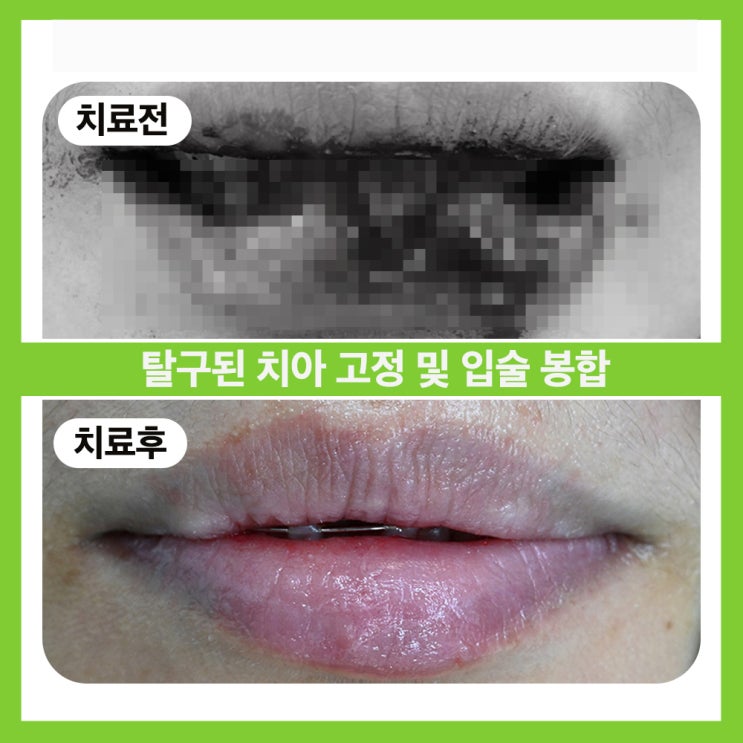  삼전역치과추천 넘어져서 입술이 찢어진 경우엔