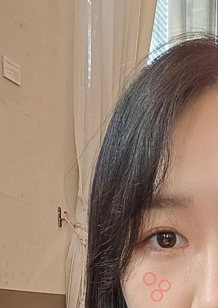 청주 편평사마귀 제거 비용 병원정보 내돈내산 후기