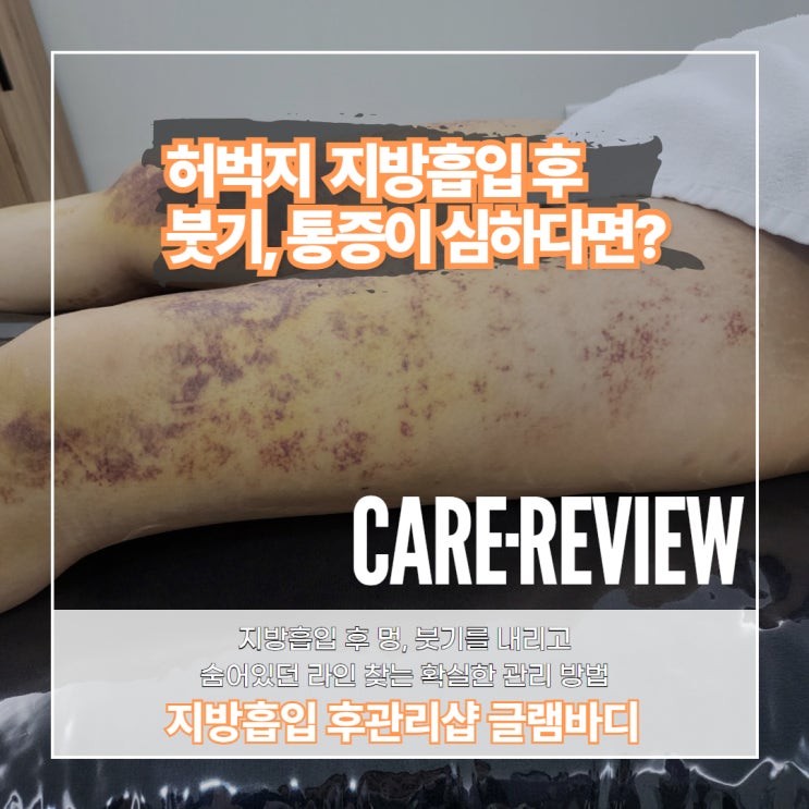  허벅지 지방흡입 후 붓기, 통증 빠르게 내리는 방법!