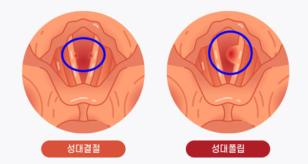 성대결절 약, 과연 정말 효과 있을까?