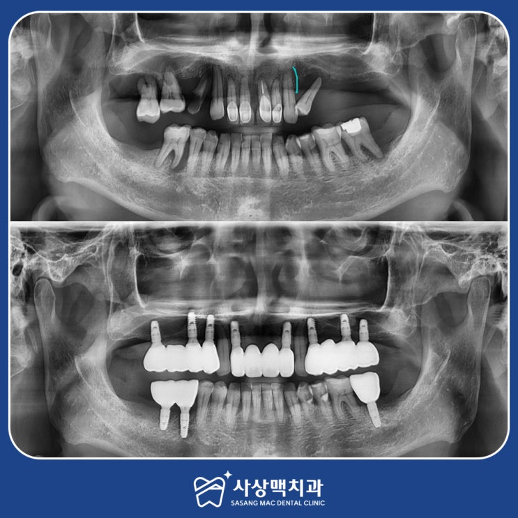  사상치과 본래의 치아와 같은 편안한 임플란트로