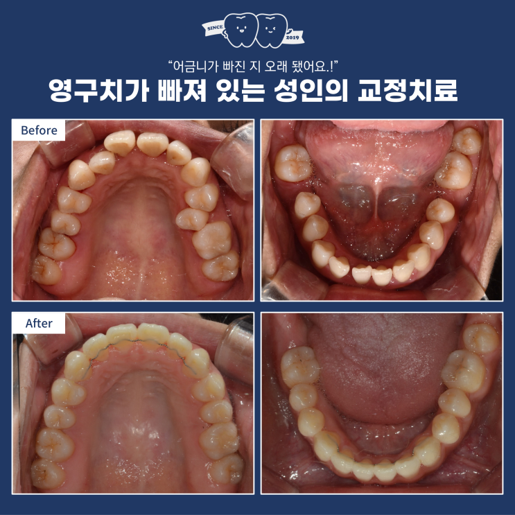 영구치가 빠진 성인 환자의 비발치 교정, 어금니가 빠진지 오래된 경우 발생될 수 있는 문제는? 하남 성인 교정 영구치가 빠진 성인 환자의 비발치 교정, 어금니가 빠진지 오래된 경우 발생될 수 있는 문제는? 하남 성인 교정