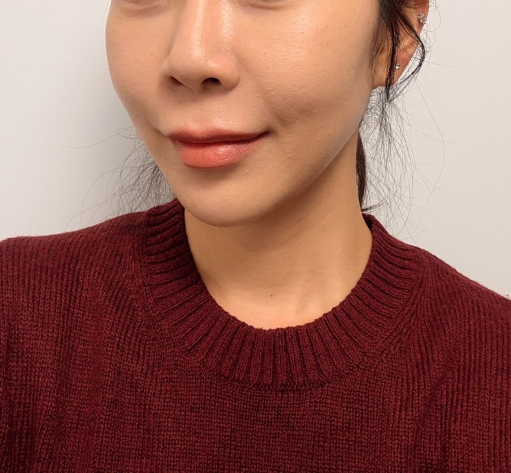  을지로입구역피부과 온다리프팅후기 | 온다 효과 주기 통증