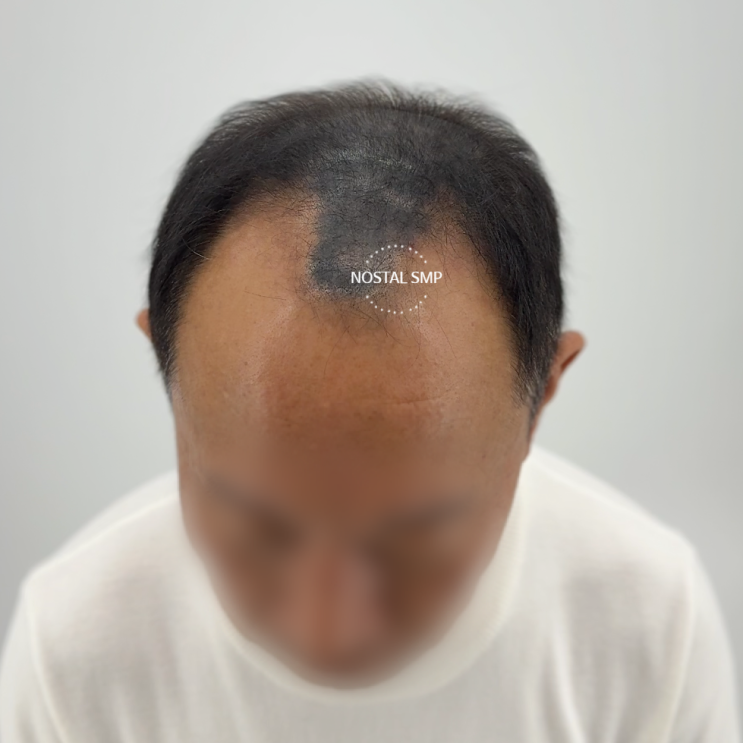  두피문신 부작용 커버 사례