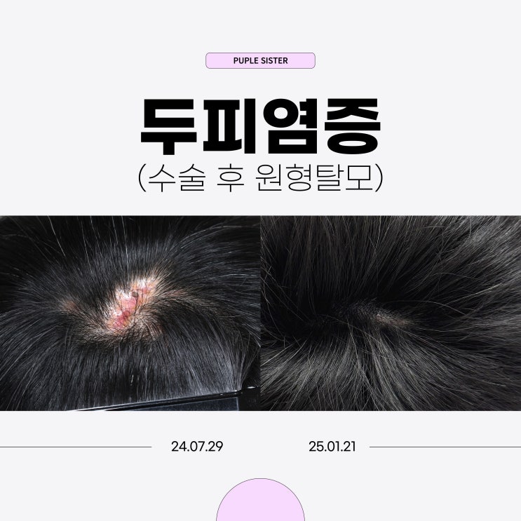  은평구피부과 두피 염증부터 탈모치료까지 한번에 해결한 후기 (리얼사진有)