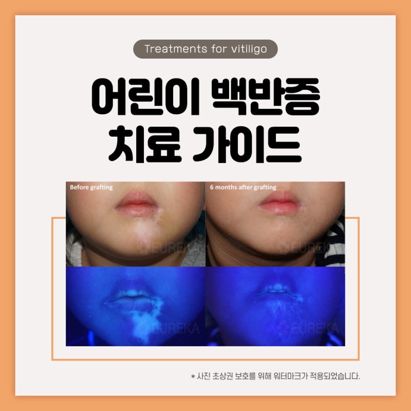 어린이 백반증, 소아 백반증 치료 가이드