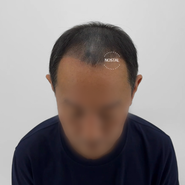  대전두피문신 부작용 극복 후기