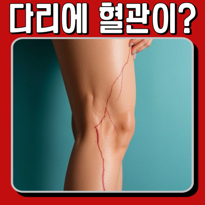 다리 혈관이 튀어나온다면? 하지 정맥류 원인부터 해결책까지!