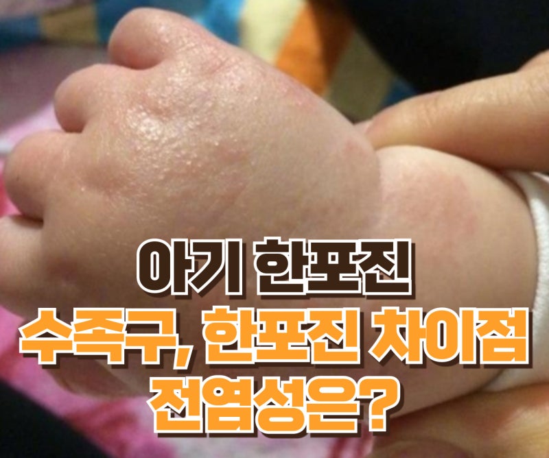 아기 한포진, 손발에 생긴 수포! 한포진과 수족구의 차이점, 전염성