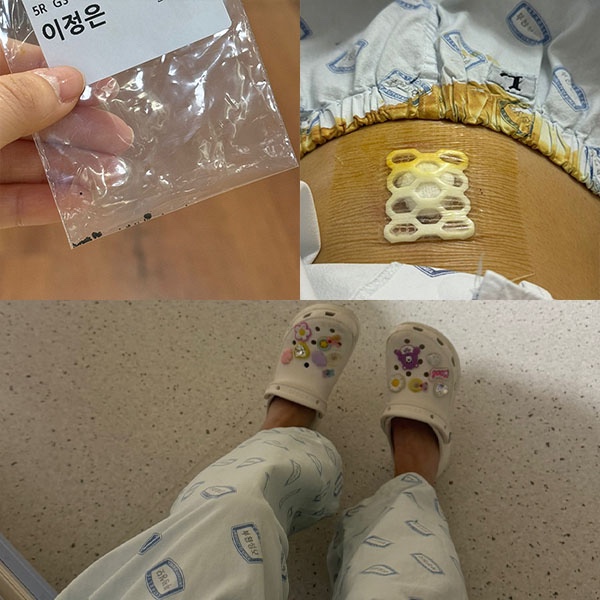  [부천성모병원] 담낭 제거 로봇 수술 3박 4일 입원 후기,비용 (수술 후 3일차)