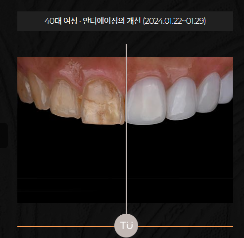 자연 치아를 지키는 무삭제라미네이트 ! 제로네이트로 완성하는 아름다운 미소