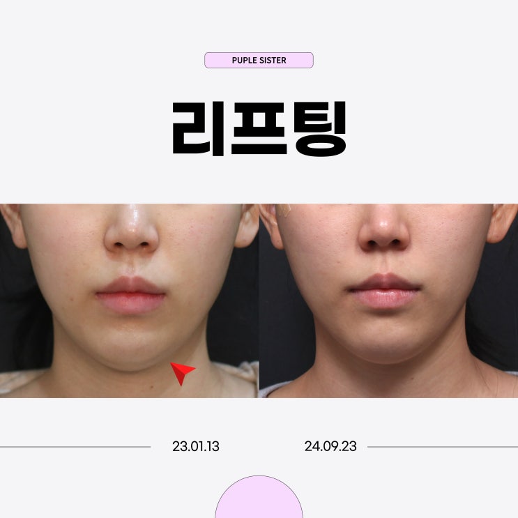  상암피부과 예비 신랑신부를 위한 빠르고 가성비 좋은 리프팅 시술 후기