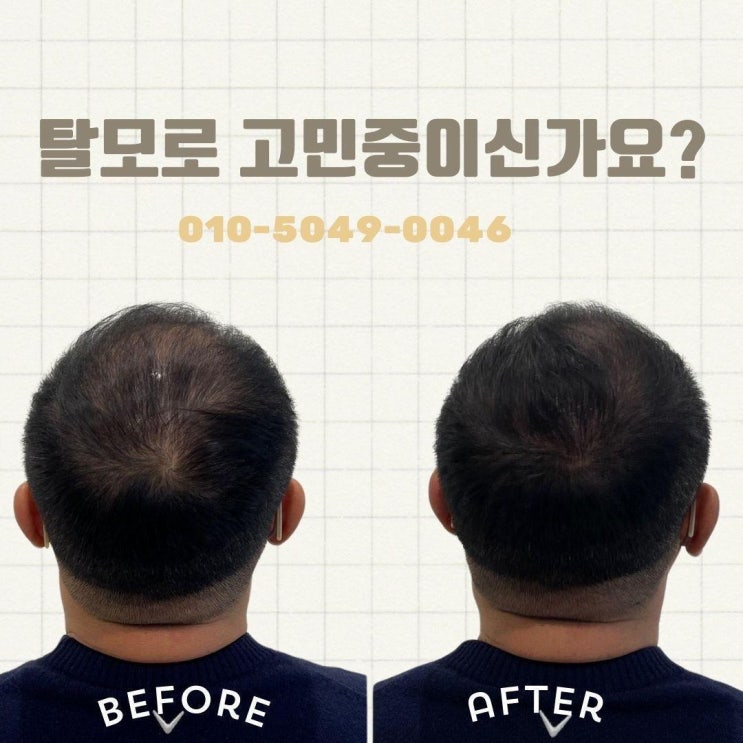  마산동의 숨겨진 보물, 두피문신: 자신감을 되찾아드립니다