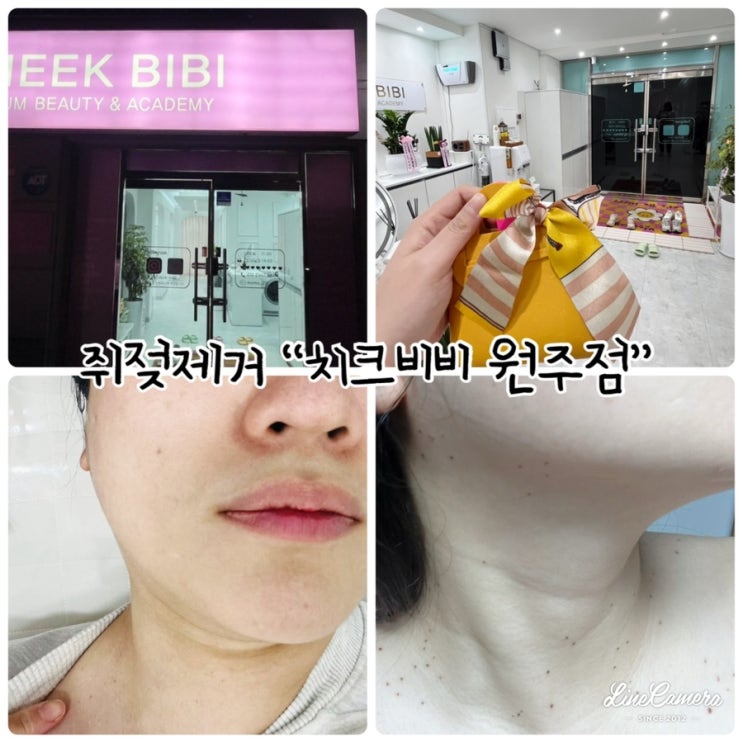  원주 쥐젖 제거 "치크비비 원주점" 문제성 피부 전문 케어