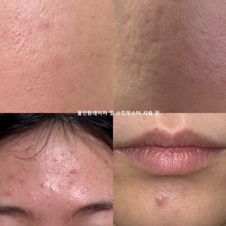 한남동 피부과 여드름 흉터제거 시술 레이저 및 올리디아마요 2주 경과 후기 한남동 피부과 여드름 흉터제거 시술 레이저 및 올리디아마요 2주 경과 후기